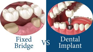 تفاوت ایمپلنت و بریج دندان